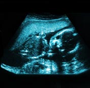 Ultrasound image of a baby inside the mothers womb